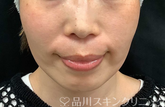 症例NO.71036のBEFORE写真