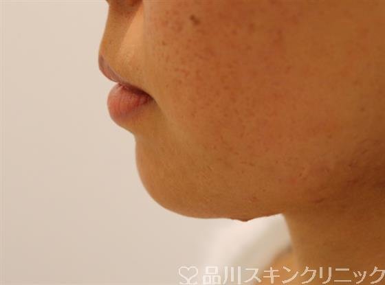 症例NO.38507のBEFORE写真