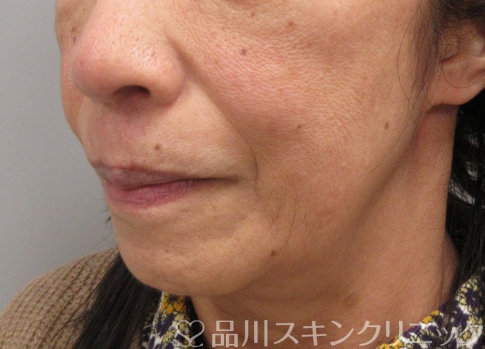 症例NO.75331のBEFORE写真