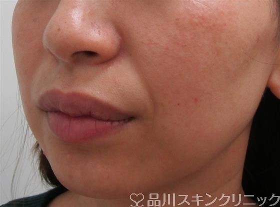 症例NO.31860のBEFORE写真