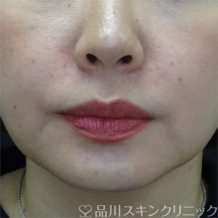 症例NO.69326のAFTER写真