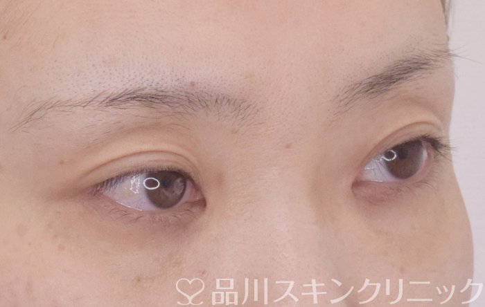症例NO.64812のBEFORE写真