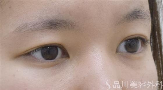症例NO.52539のBEFORE写真