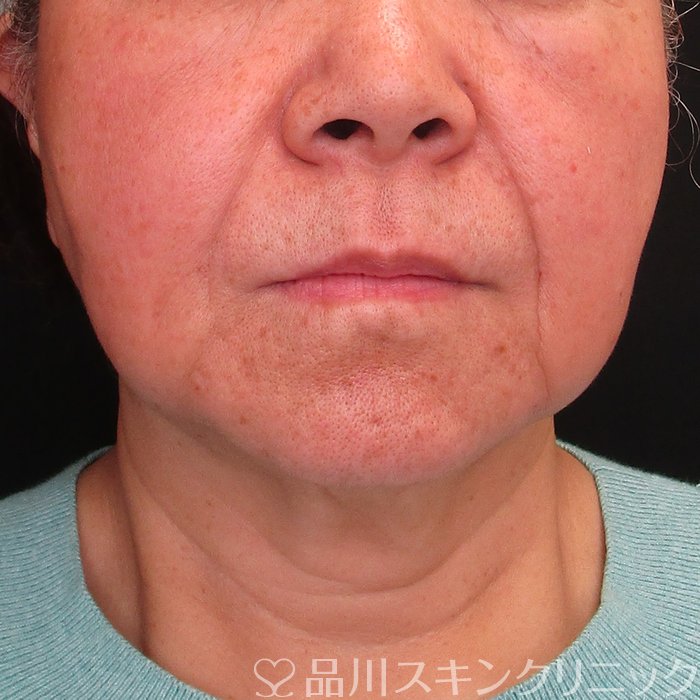 症例NO.73804のAFTER写真
