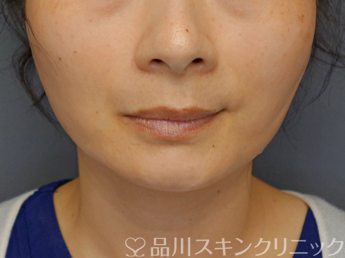 症例NO.70967のAFTER写真
