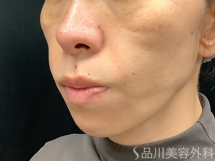 症例NO.67760のBEFORE写真