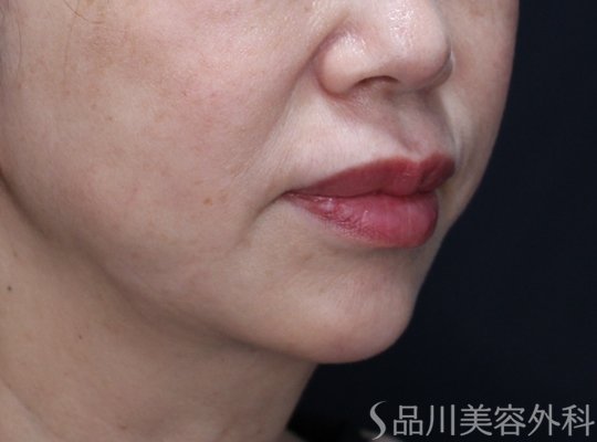 症例NO.72376のAFTER写真