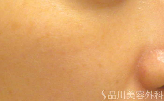 症例NO.74035のAFTER写真