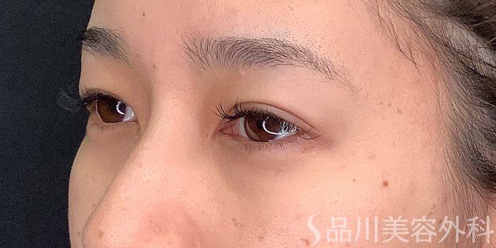 症例NO.71238のBEFORE写真