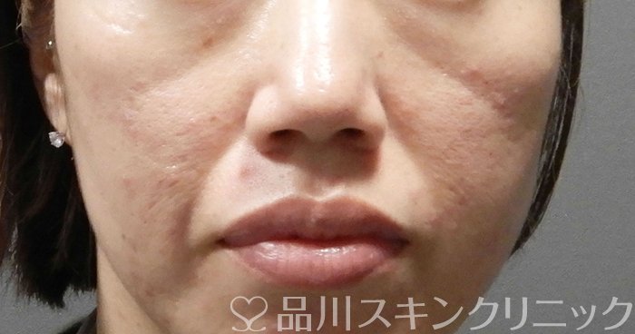 症例NO.65562のBEFORE写真