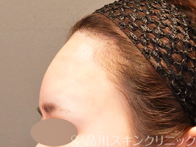 症例NO.70115のAFTER写真