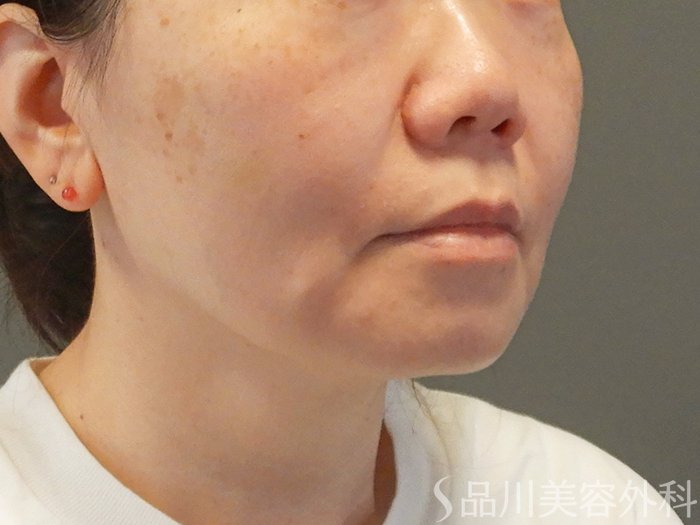 症例NO.67900のAFTER写真