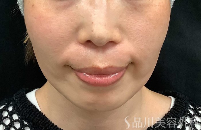 症例NO.71036のBEFORE写真
