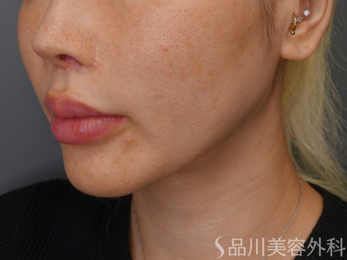 症例NO.71671のBEFORE写真