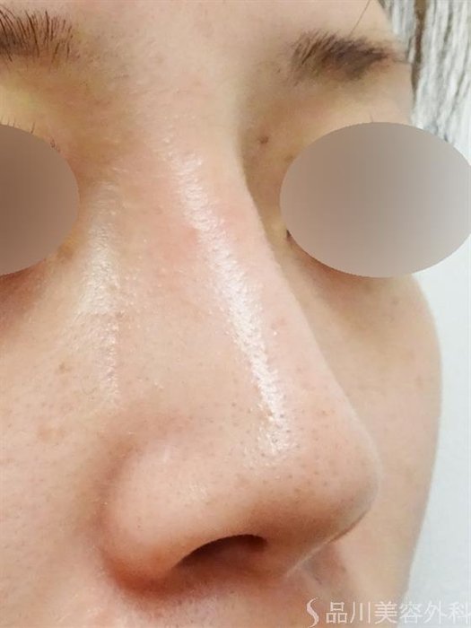 症例NO.43849のAFTER写真