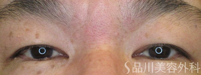 症例NO.70155のBEFORE写真