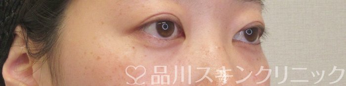 症例NO.74203のAFTER写真