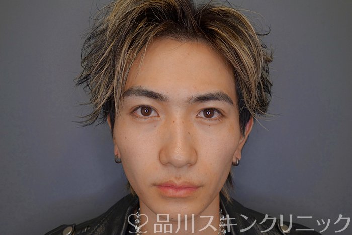 症例NO.73977のAFTER写真