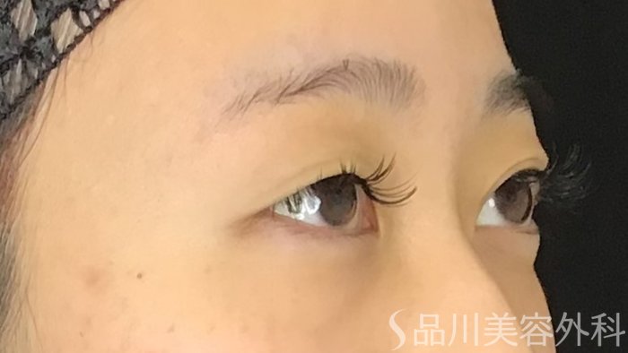 症例NO.69635のBEFORE写真