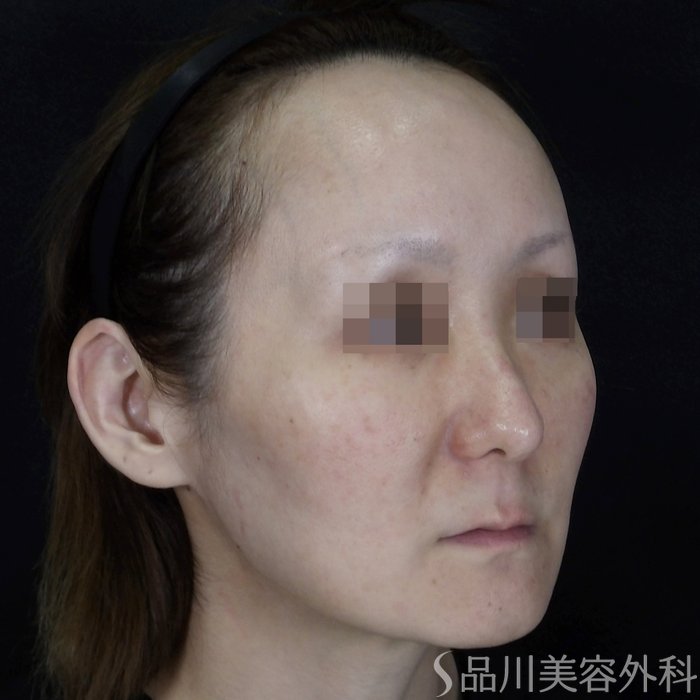 症例NO.70274のBEFORE写真