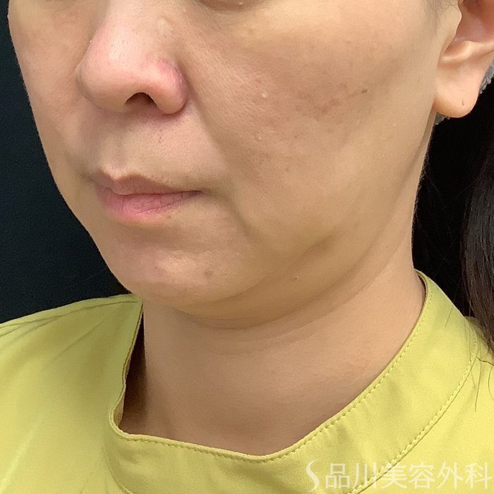 症例NO.75329のBEFORE写真