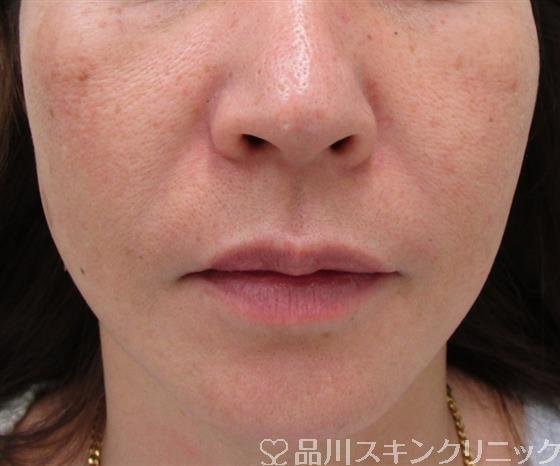 症例NO.32796のBEFORE写真