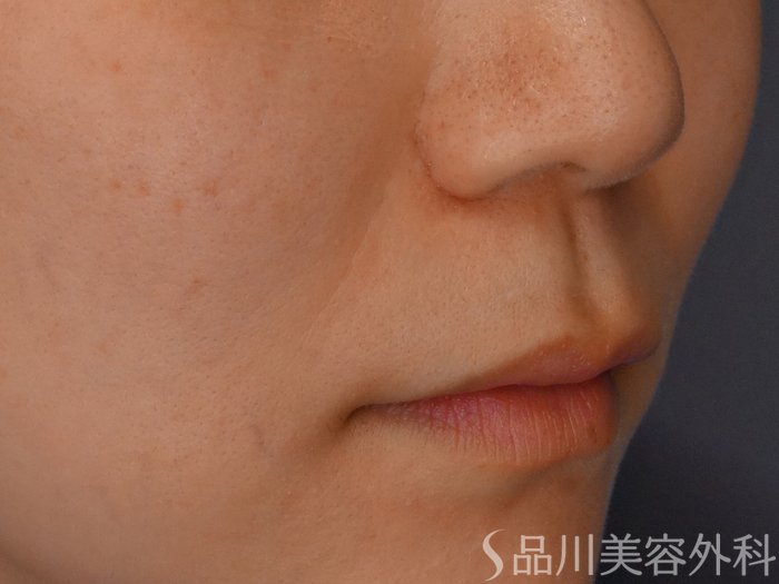 症例NO.68278のBEFORE写真