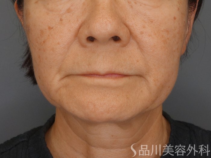 症例NO.65052のBEFORE写真