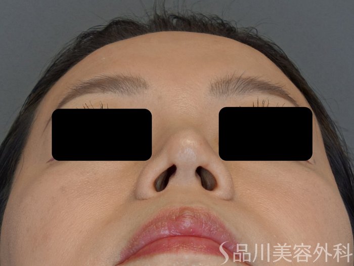 症例NO.74343のAFTER写真