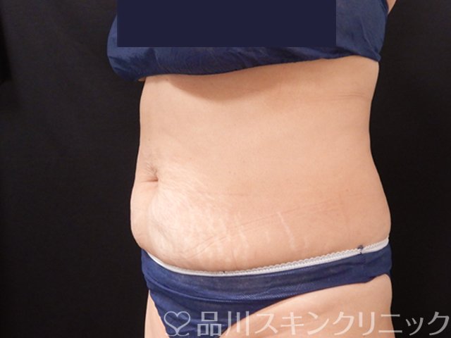 症例NO.68086のAFTER写真