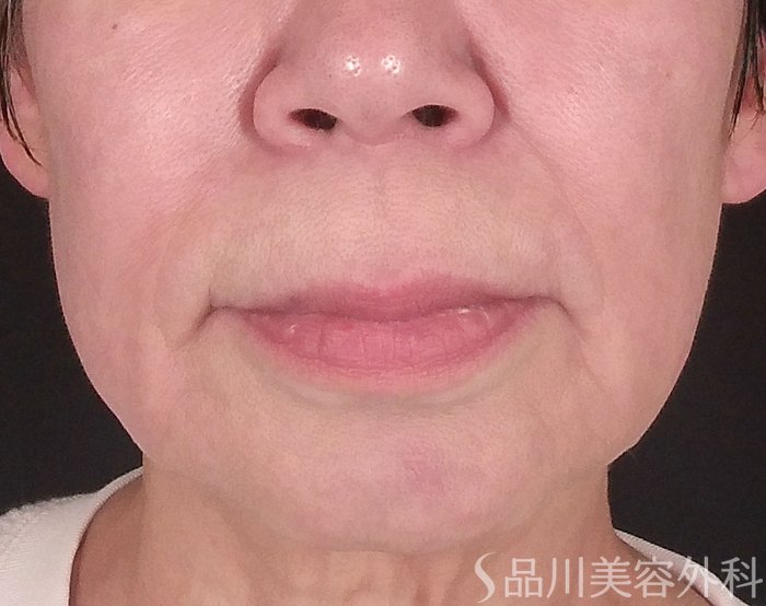 症例NO.70354のBEFORE写真