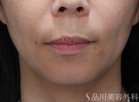 症例NO.71458のBEFORE写真