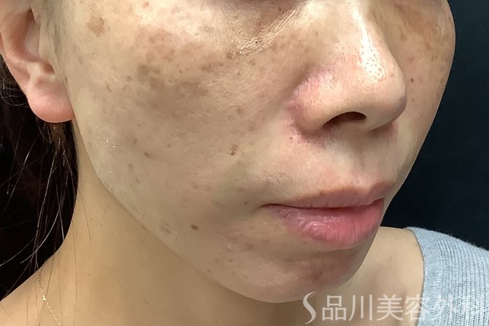 症例NO.63240のAFTER写真