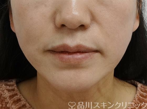 症例NO.44843のAFTER写真