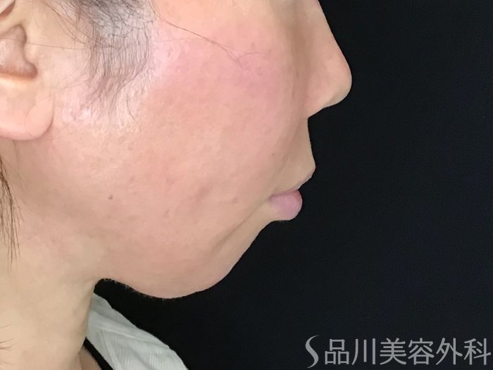症例NO.69744のBEFORE写真