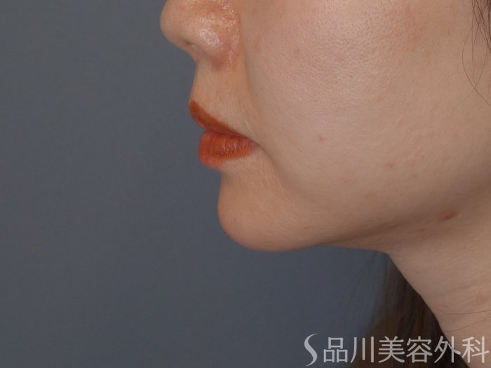 症例NO.72416のAFTER写真