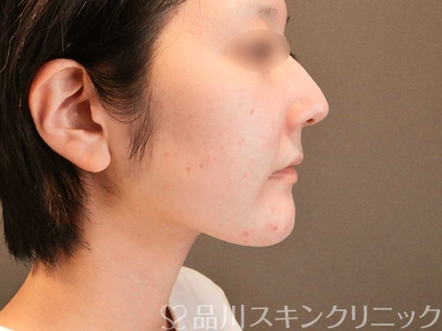 症例NO.65570のBEFORE写真