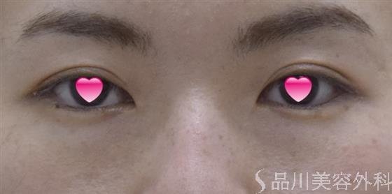 症例NO.52121のBEFORE写真