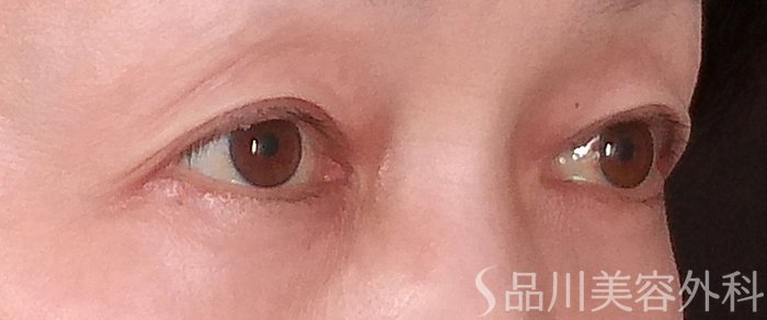 症例NO.69940のBEFORE写真