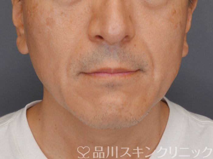 症例NO.71089のBEFORE写真