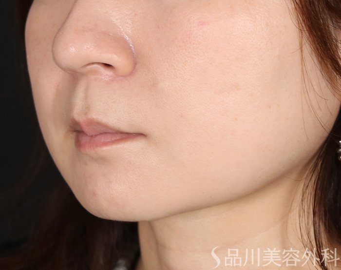 症例NO.72389のAFTER写真