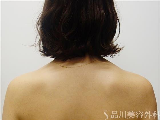 症例NO.50492のBEFORE写真