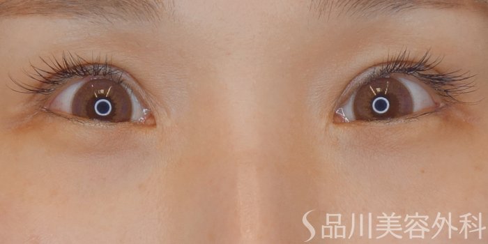 症例NO.71925のBEFORE写真