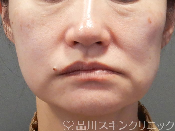 症例NO.72393のBEFORE写真