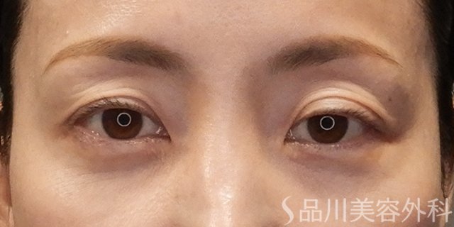 症例NO.74797のBEFORE写真