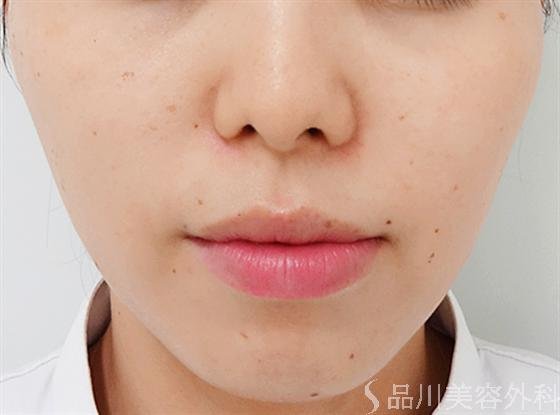 症例NO.14184のAFTER写真
