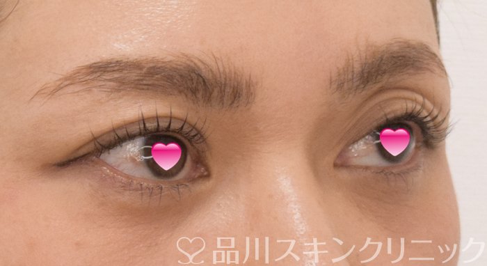 症例NO.74276のAFTER写真