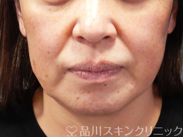 症例NO.69191のBEFORE写真