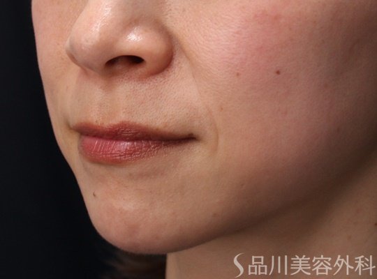 症例NO.69674のBEFORE写真
