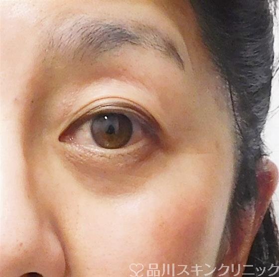 症例NO.48355のAFTER写真